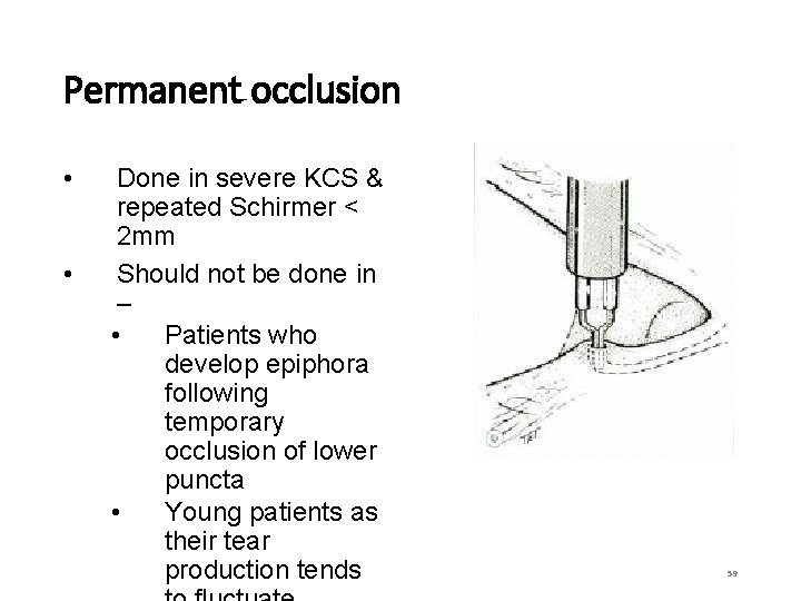 Permanent occlusion • • Done in severe KCS & repeated Schirmer < 2 mm