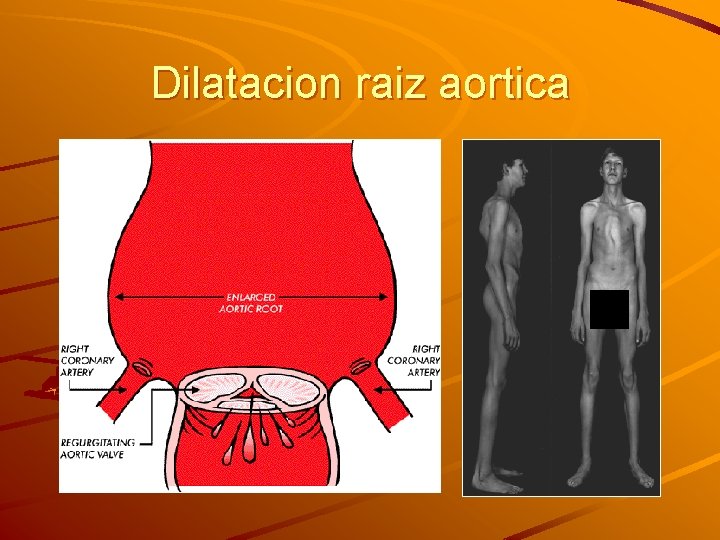 Dilatacion raiz aortica Dilatacion raiz aortica