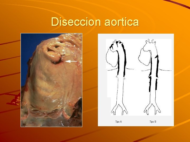 Diseccion aortica 