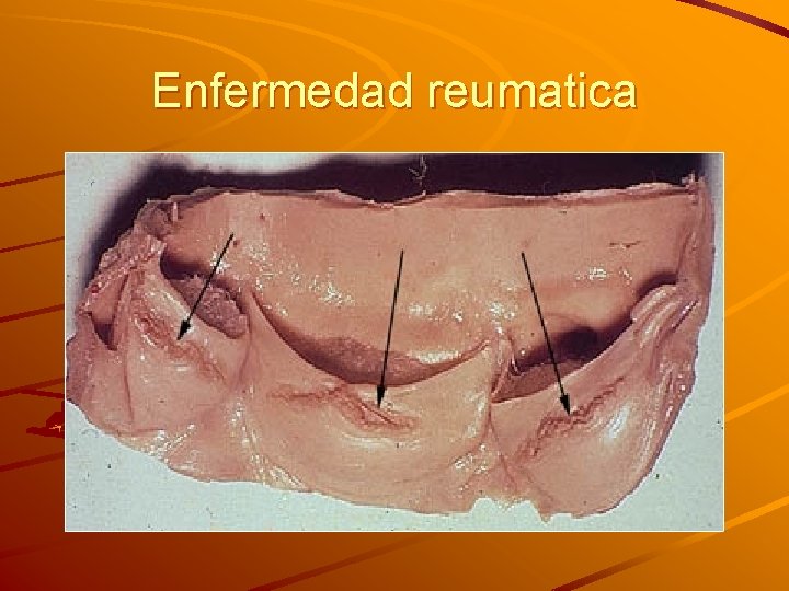Enfermedad reumatica Enfermedad reumatica