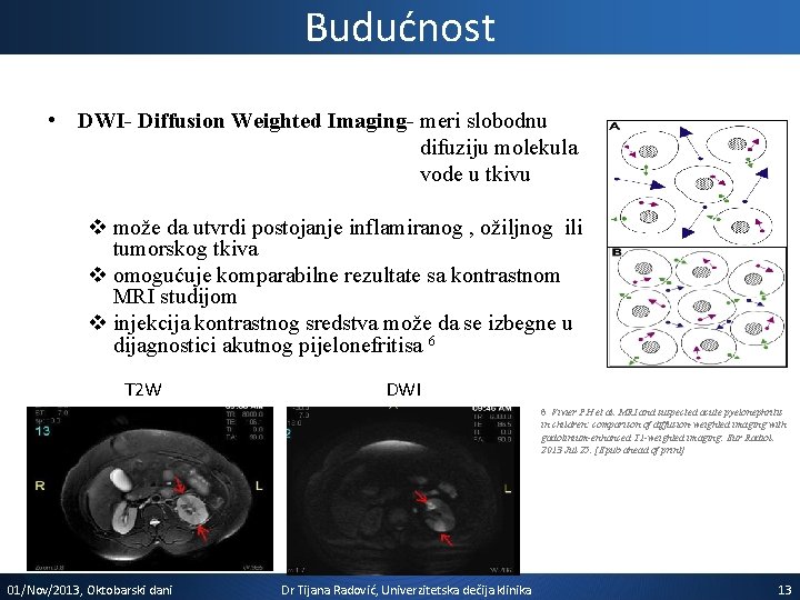 Budućnost • DWI- Diffusion Weighted Imaging- meri slobodnu difuziju molekula vode u tkivu v