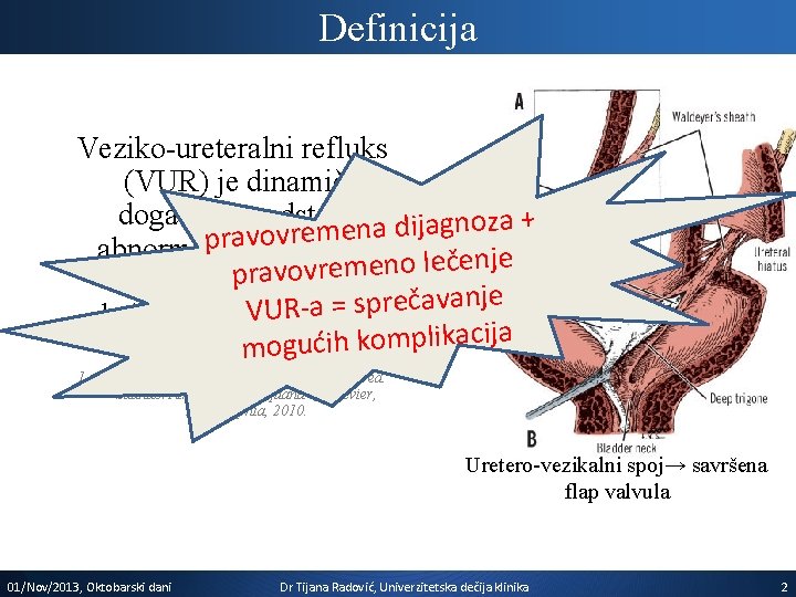 Definicija Veziko-ureteralni refluks (VUR) je dinamički događaj i predstavlja + a z o n