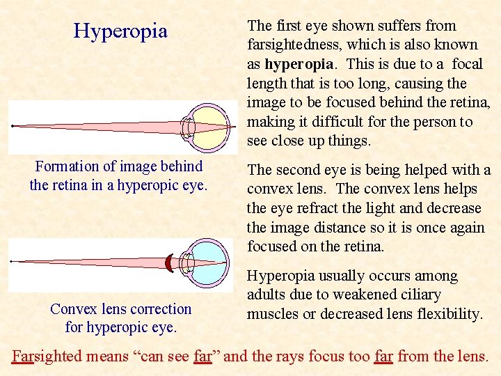 Hyperopia The first eye shown suffers from farsightedness, which is also known as hyperopia.