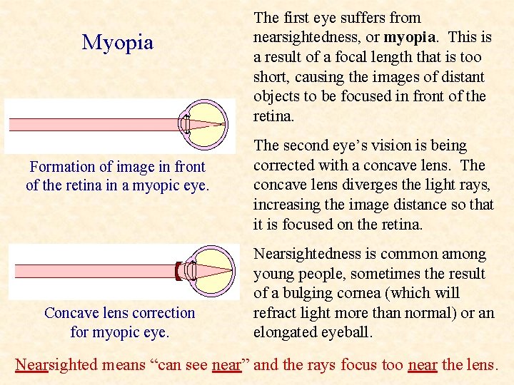 Myopia Formation of image in front of the retina in a myopic eye. Concave