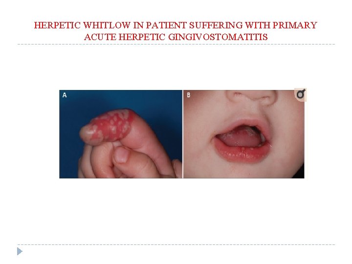 HERPETIC WHITLOW IN PATIENT SUFFERING WITH PRIMARY ACUTE HERPETIC GINGIVOSTOMATITIS 