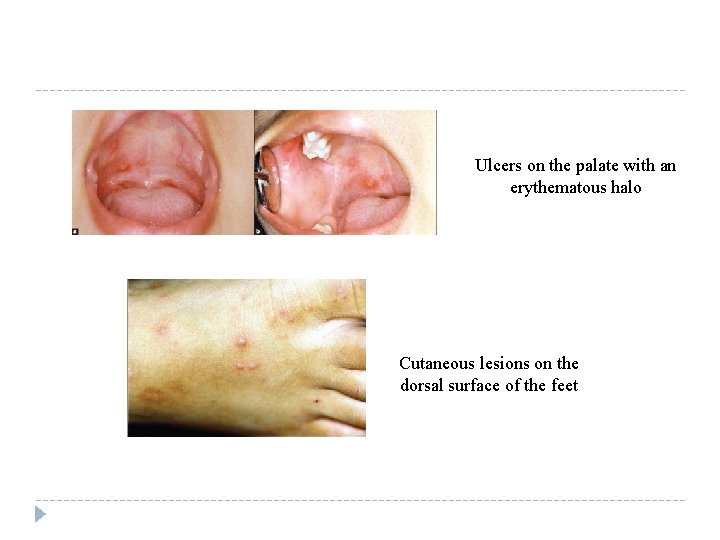 Ulcers on the palate with an erythematous halo Cutaneous lesions on the dorsal surface