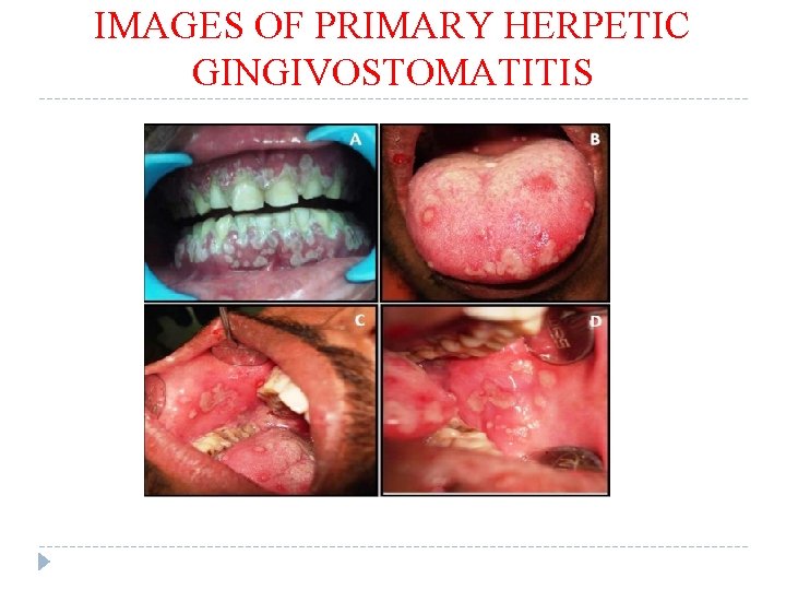 IMAGES OF PRIMARY HERPETIC GINGIVOSTOMATITIS 