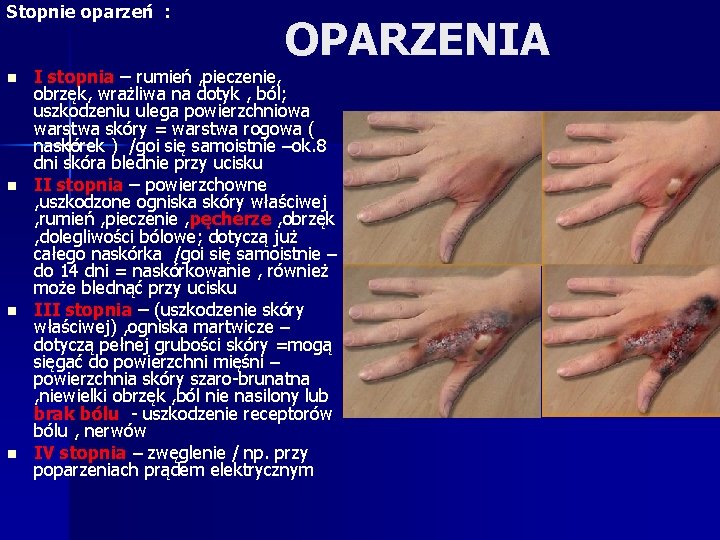 Stopnie oparzeń : n n OPARZENIA I stopnia – rumień , pieczenie, obrzęk, wrażliwa