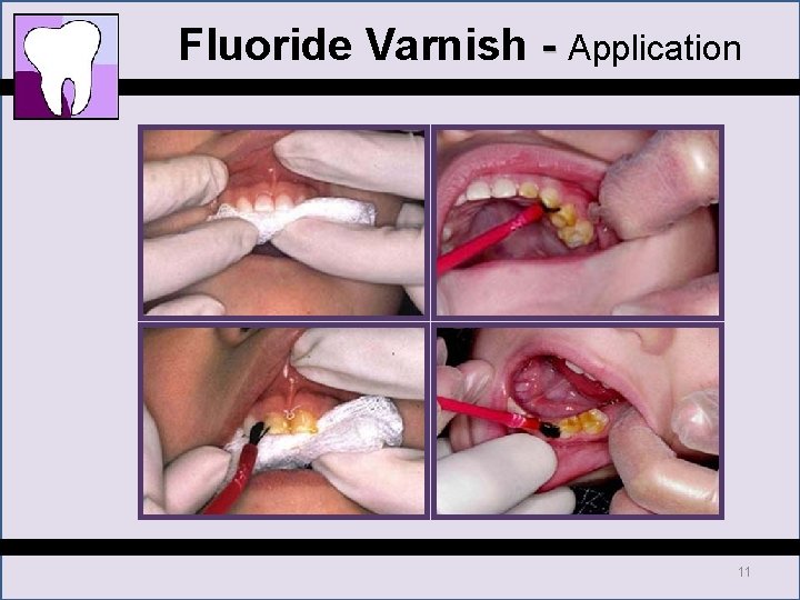 Fluoride Varnish - Application 11 Fluoride Varnish - Application 11
