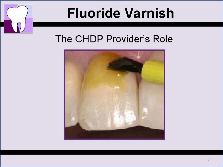 Fluoride Varnish The CHDP Provider’s Role 3 Fluoride Varnish The CHDP Provider’s Role 3