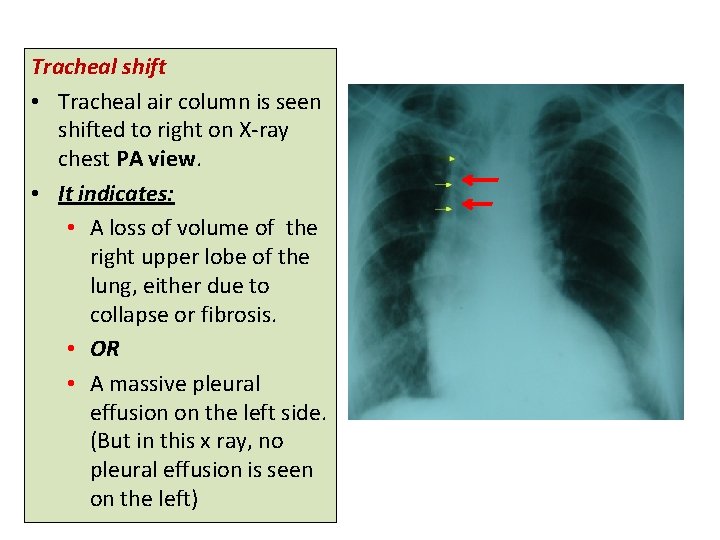 Tracheal shift • Tracheal air column is seen shifted to right on X-ray chest Tracheal shift • Tracheal air column is seen shifted to right on X-ray chest