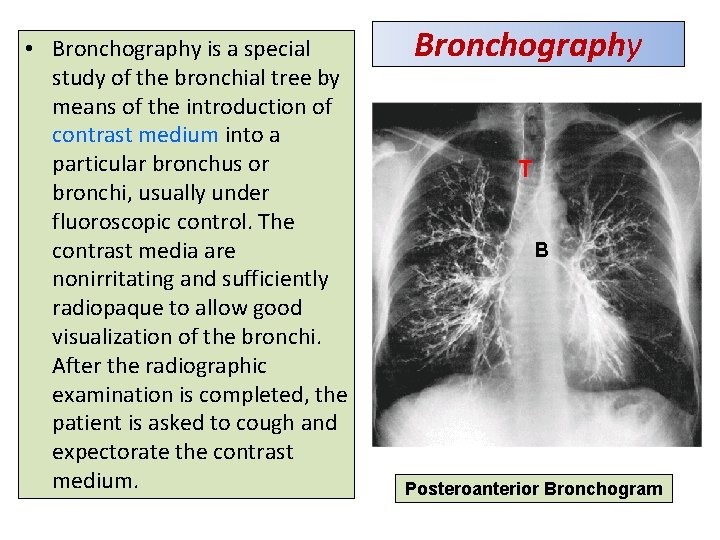 • Bronchography is a special study of the bronchial tree by means of • Bronchography is a special study of the bronchial tree by means of