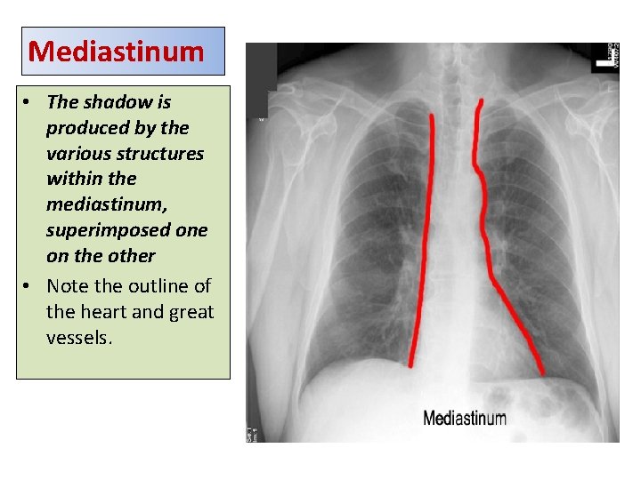 Mediastinum • The shadow is produced by the various structures within the mediastinum, superimposed Mediastinum • The shadow is produced by the various structures within the mediastinum, superimposed