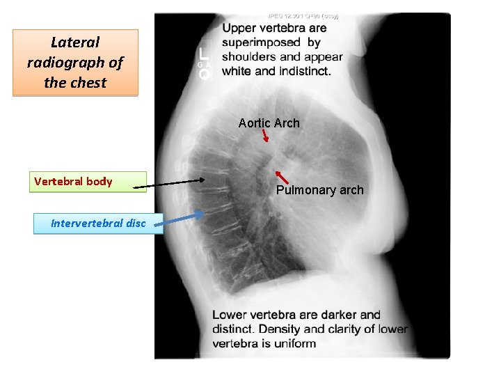 Lateral radiograph of the chest Aortic Arch Vertebral body Intervertebral disc Pulmonary arch Lateral radiograph of the chest Aortic Arch Vertebral body Intervertebral disc Pulmonary arch
