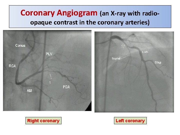Coronary Angiogram (an X-ray with radioopaque contrast in the coronary arteries) Right coronary Left Coronary Angiogram (an X-ray with radioopaque contrast in the coronary arteries) Right coronary Left