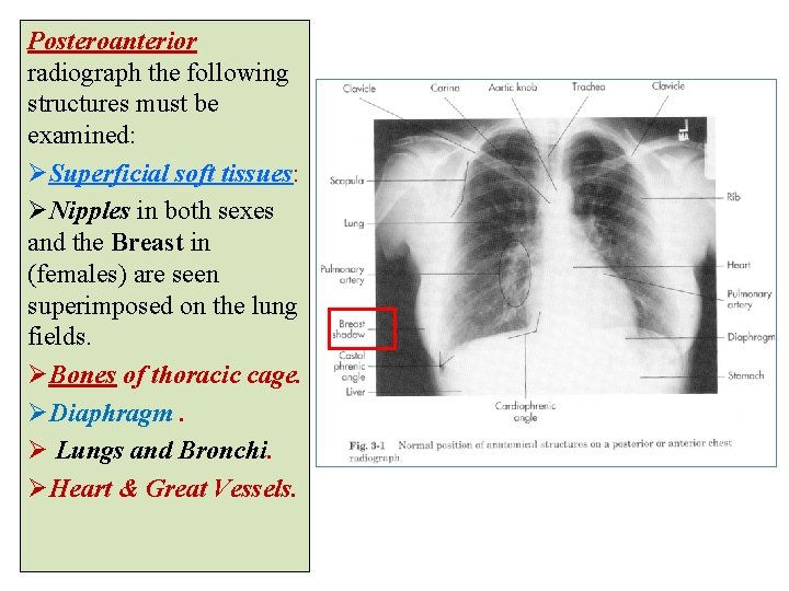 Posteroanterior radiograph the following structures must be examined: ØSuperficial soft tissues: ØNipples in both Posteroanterior radiograph the following structures must be examined: ØSuperficial soft tissues: ØNipples in both