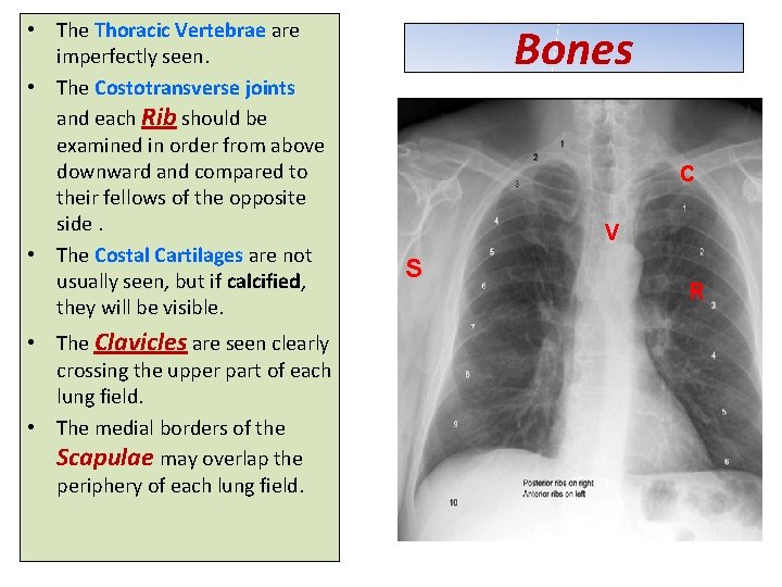 • The Thoracic Vertebrae are imperfectly seen. • The Costotransverse joints and each • The Thoracic Vertebrae are imperfectly seen. • The Costotransverse joints and each