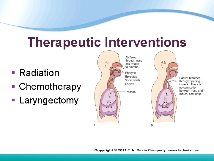 Therapeutic Interventions § Radiation § Chemotherapy § Laryngectomy Therapeutic Interventions § Radiation § Chemotherapy § Laryngectomy