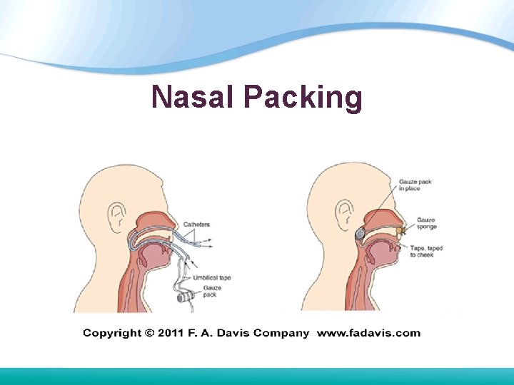 Nasal Packing Nasal Packing