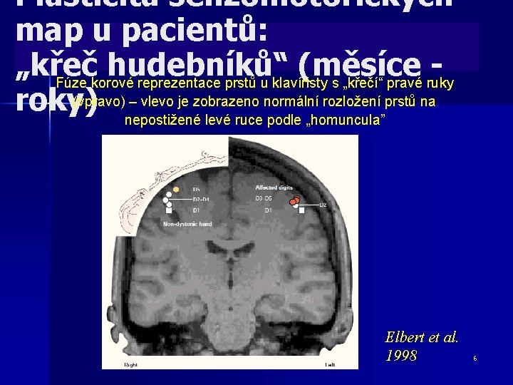 Plasticita senzomotorických map u pacientů: „křeč hudebníků“ (měsíce Fúze korové reprezentace prstů u klavíristy