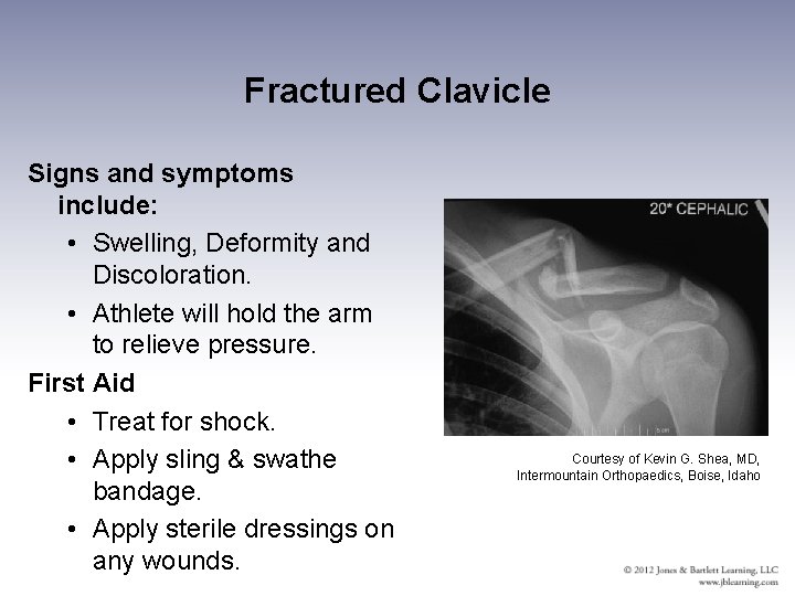 Fractured Clavicle Signs and symptoms include: • Swelling, Deformity and Discoloration. • Athlete will