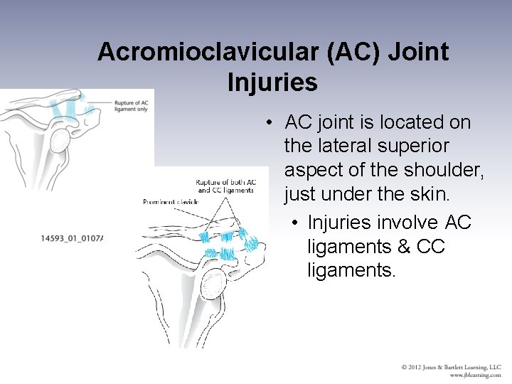 Acromioclavicular (AC) Joint Injuries • AC joint is located on the lateral superior aspect