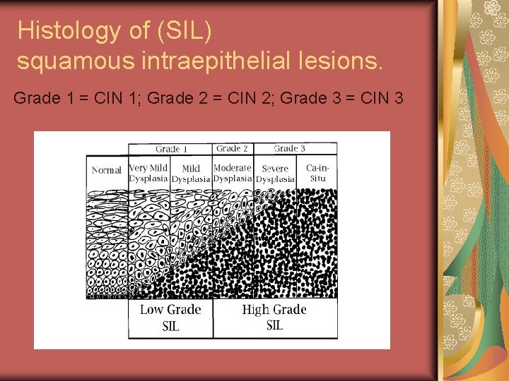 Histology of (SIL) squamous intraepithelial lesions. Grade 1 = CIN 1; Grade 2 =