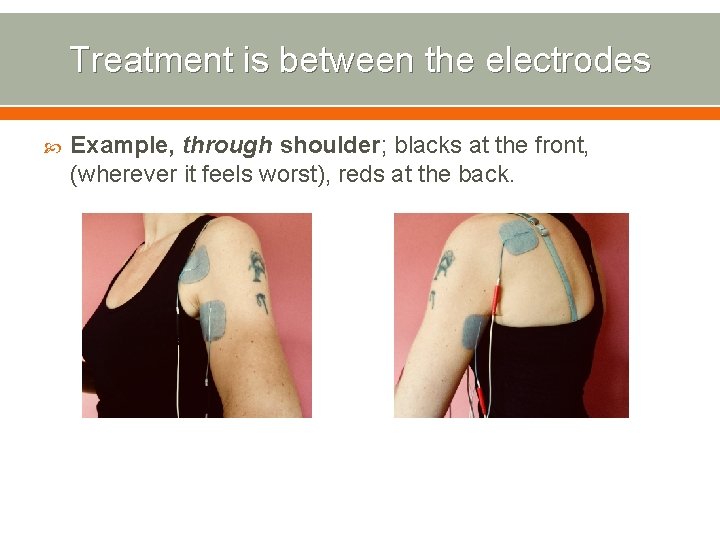 Treatment is between the electrodes Example, through shoulder; blacks at the front, (wherever it