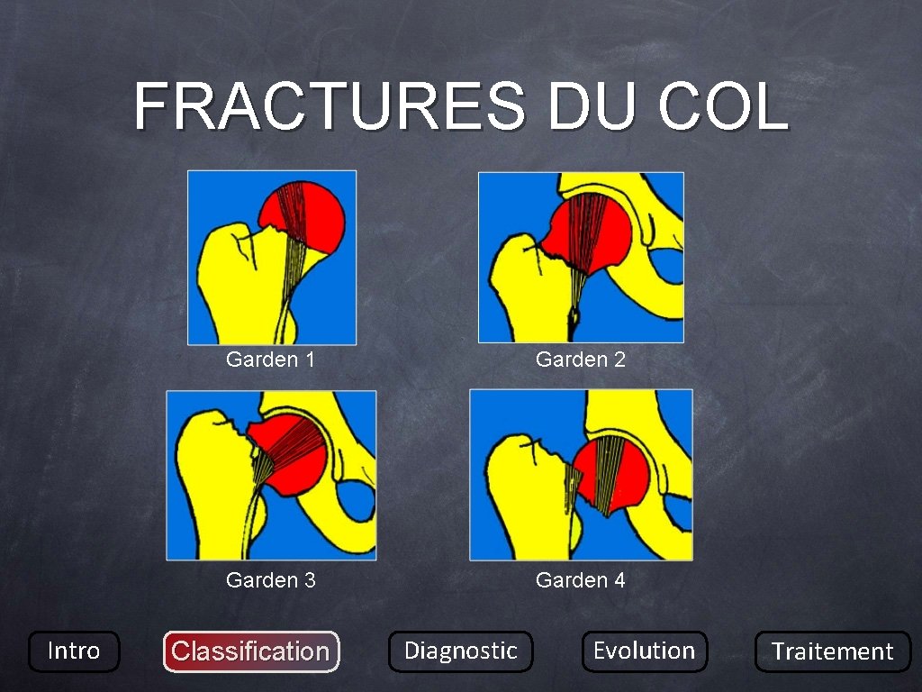 FRACTURES DU COL Intro Garden 1 Garden 2 Garden 3 Garden 4 Classification Diagnostic