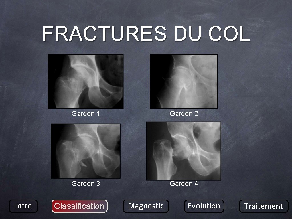 FRACTURES DU COL Intro Garden 1 Garden 2 Garden 3 Garden 4 Classification Diagnostic