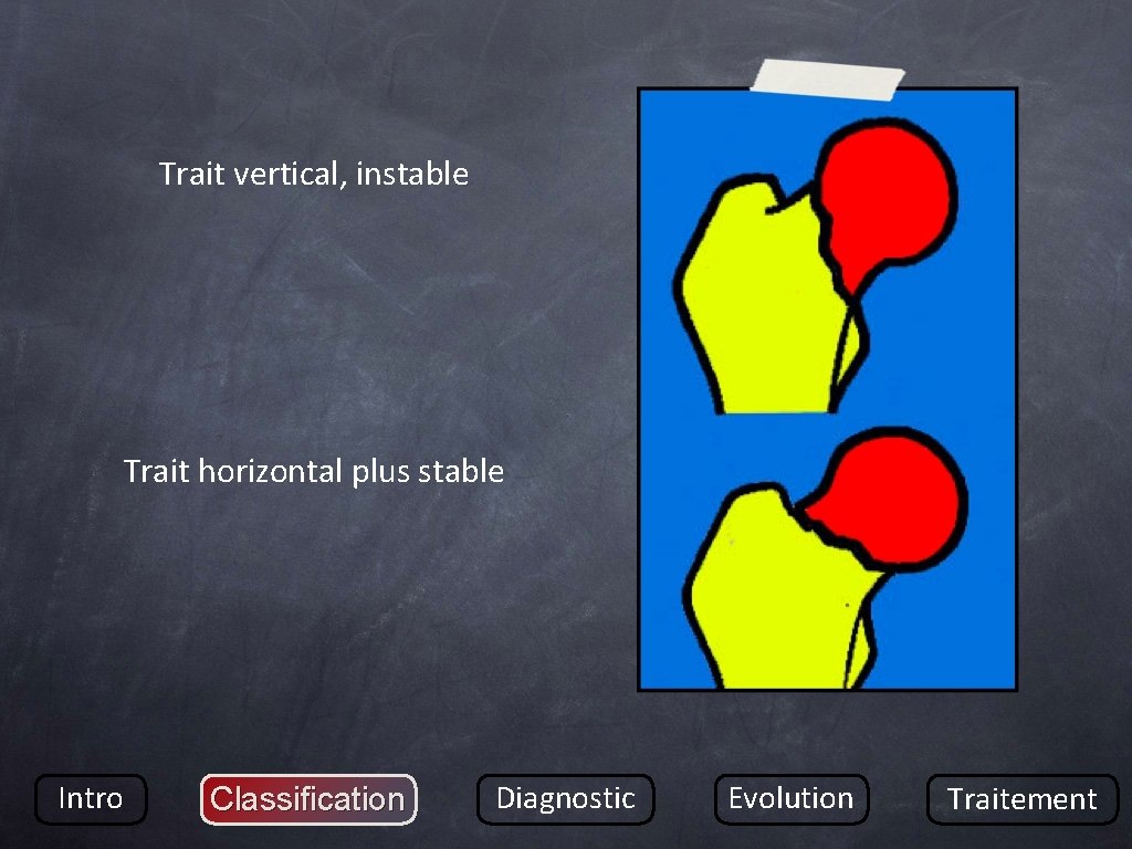 Trait vertical, instable Trait horizontal plus stable Intro Classification Diagnostic Evolution Traitement 