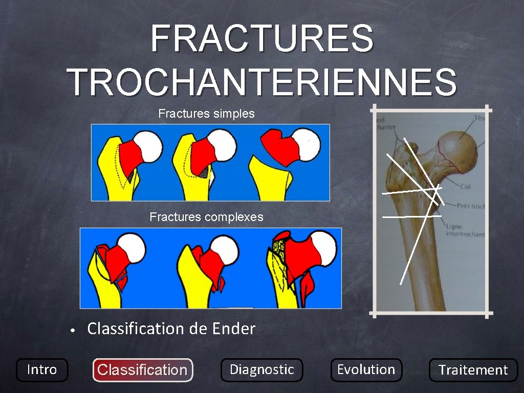 FRACTURES TROCHANTERIENNES Fractures simples Fractures complexes • Intro Classification de Ender Classification Diagnostic Evolution