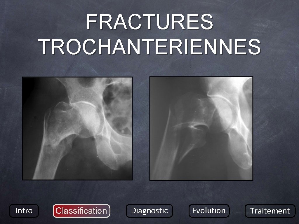 FRACTURES TROCHANTERIENNES Intro Classification Diagnostic Evolution Traitement 
