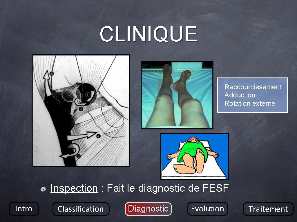 CLINIQUE Raccourcissement Adduction Rotation externe Inspection : Fait le diagnostic de FESF Intro Classification