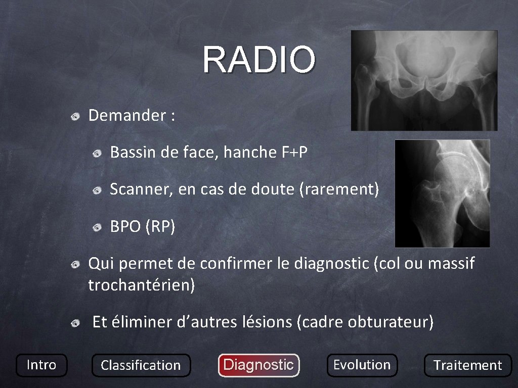 RADIO Demander : Bassin de face, hanche F+P Scanner, en cas de doute (rarement)