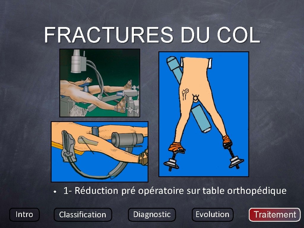 FRACTURES DU COL • Intro 1 - Réduction pré opératoire sur table orthopédique Classification