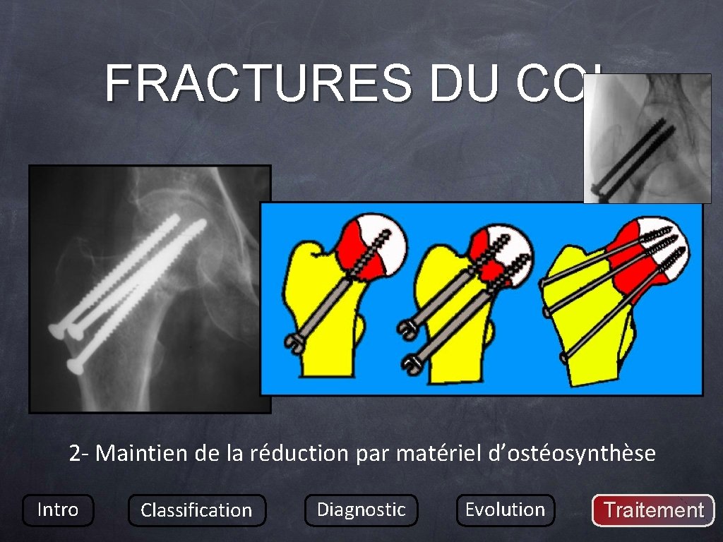 FRACTURES DU COL 2 - Maintien de la réduction par matériel d’ostéosynthèse Intro Classification