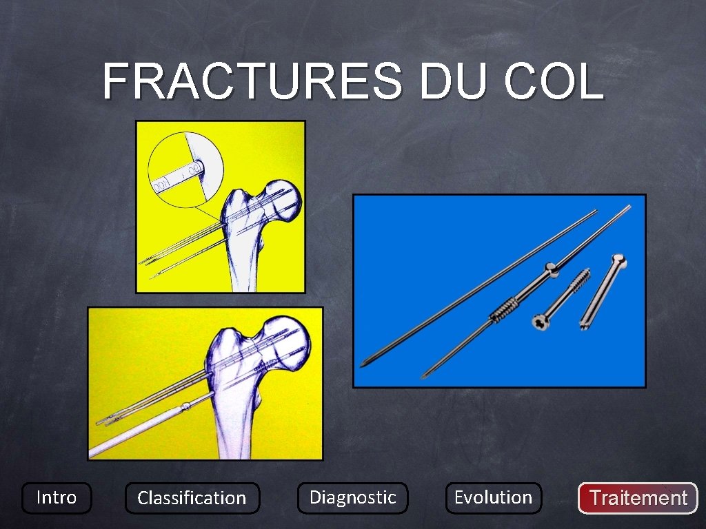 FRACTURES DU COL Intro Classification Diagnostic Evolution Traitement 