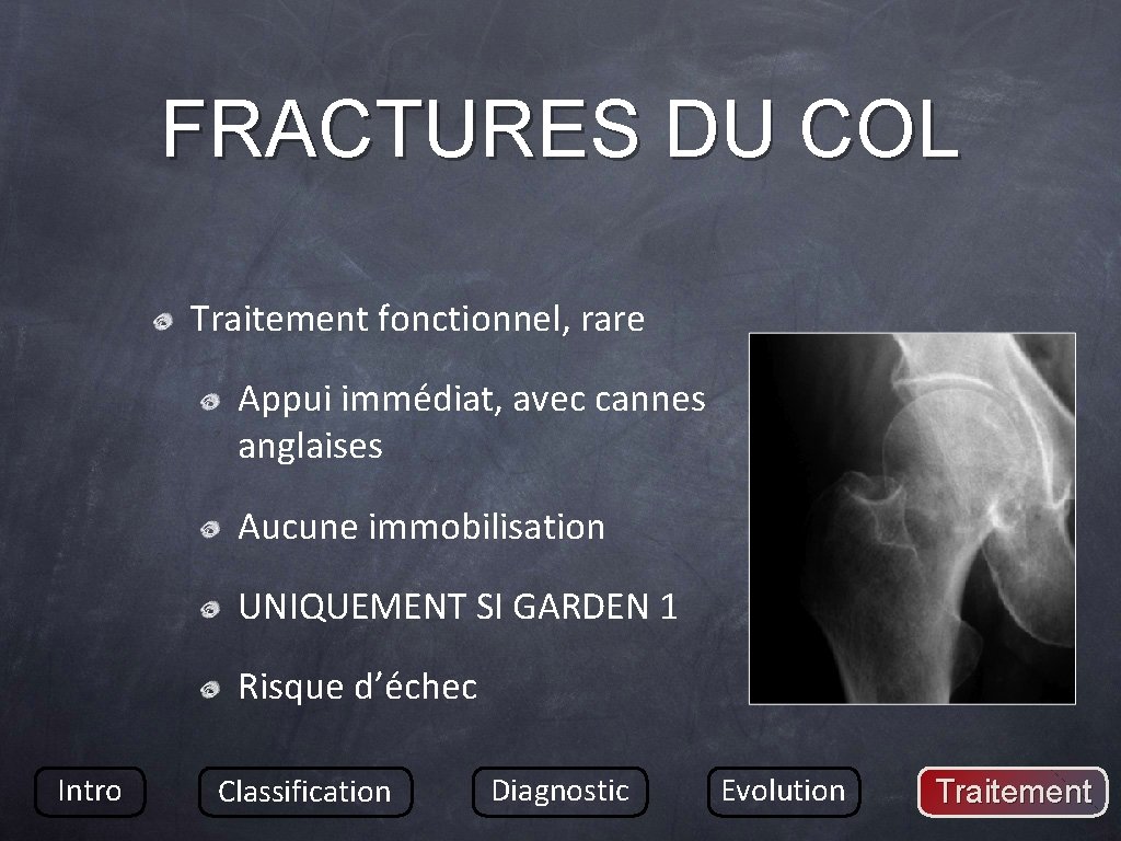 FRACTURES DU COL Traitement fonctionnel, rare Appui immédiat, avec cannes anglaises Aucune immobilisation UNIQUEMENT