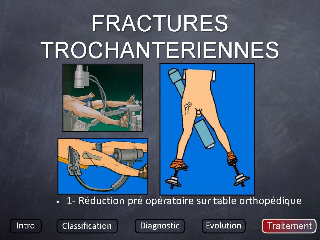 FRACTURES TROCHANTERIENNES • Intro 1 - Réduction pré opératoire sur table orthopédique Classification Diagnostic