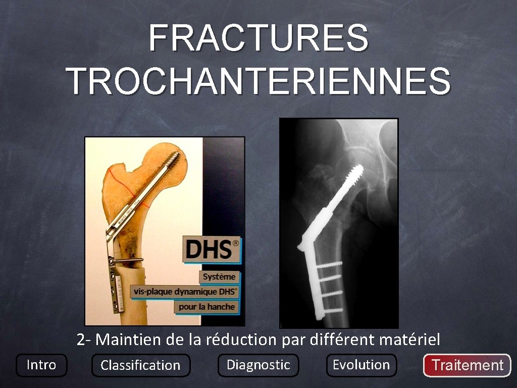 FRACTURES TROCHANTERIENNES 2 - Maintien de la réduction par différent matériel Intro Classification Diagnostic