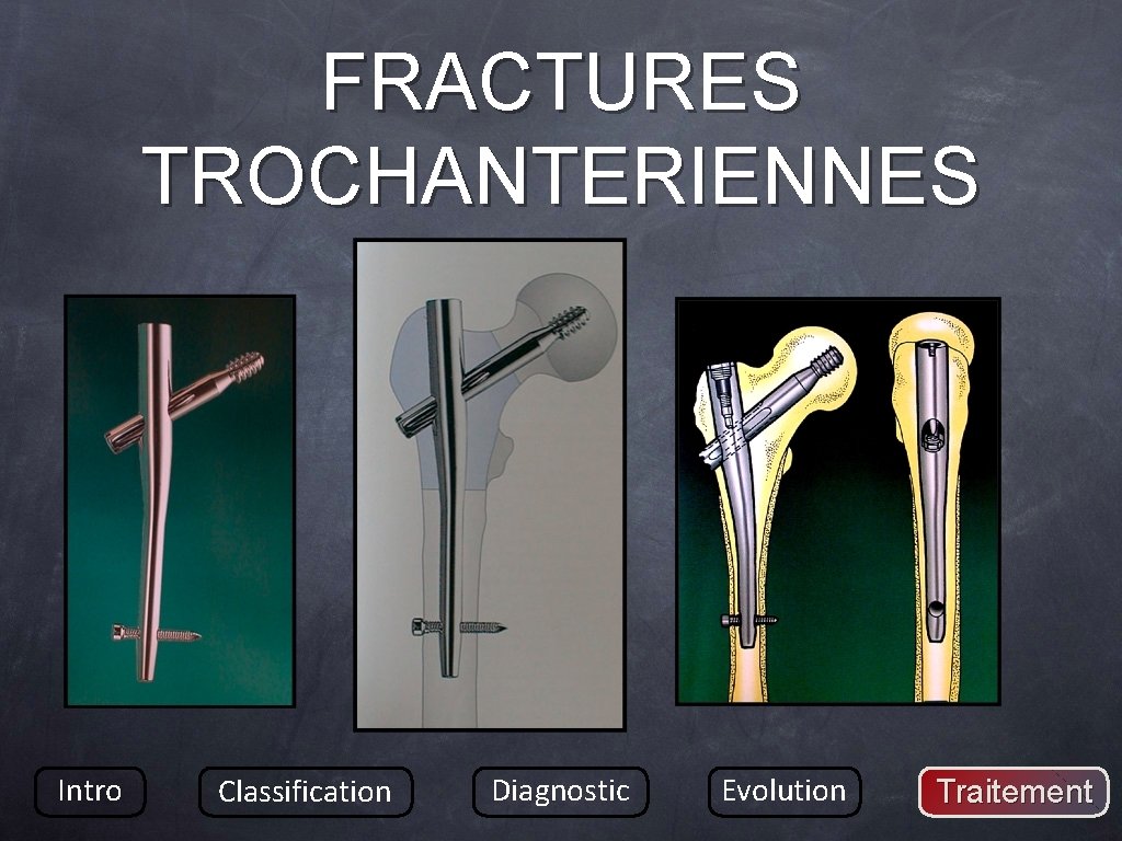 FRACTURES TROCHANTERIENNES Intro Classification Diagnostic Evolution Traitement 