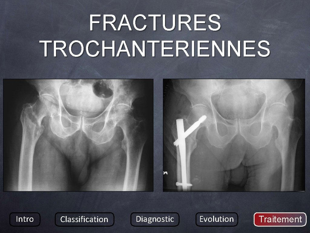 FRACTURES TROCHANTERIENNES Intro Classification Diagnostic Evolution Traitement 