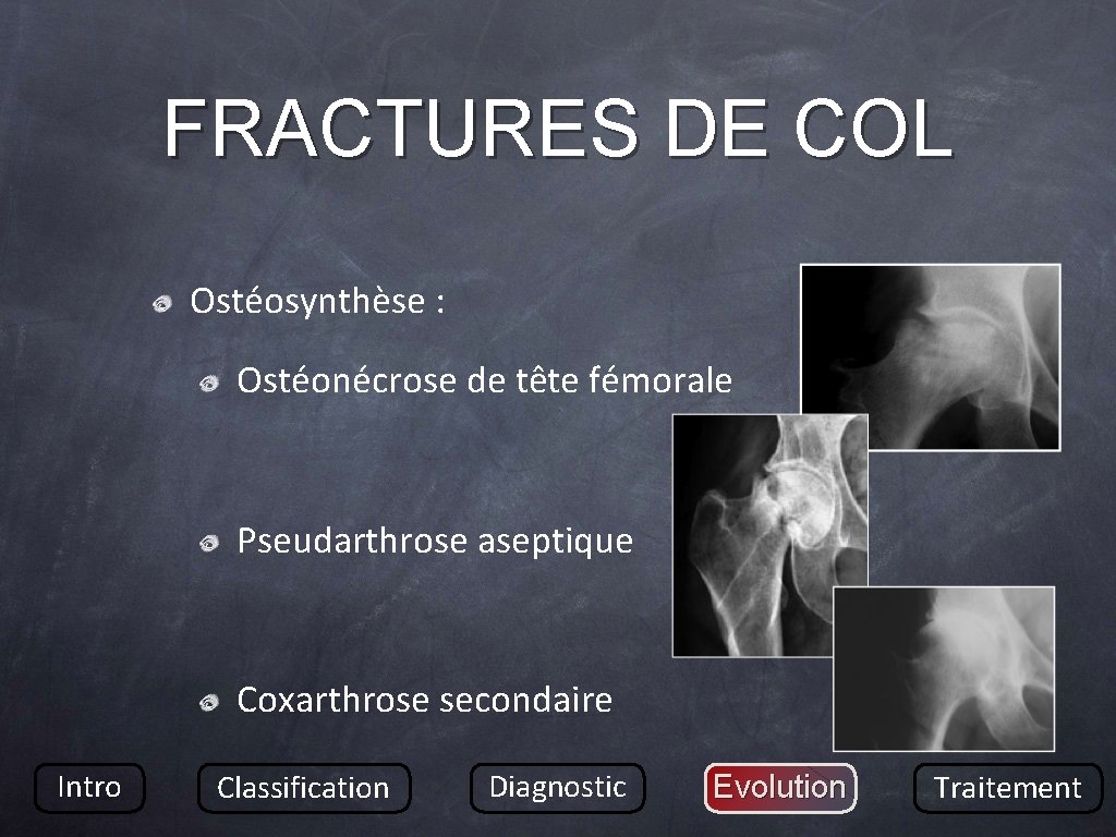 FRACTURES DE COL Ostéosynthèse : Ostéonécrose de tête fémorale Pseudarthrose aseptique Coxarthrose secondaire Intro