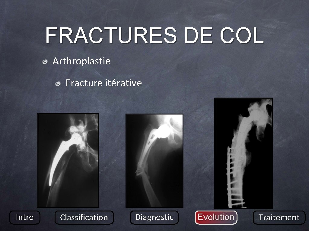 FRACTURES DE COL Arthroplastie Fracture itérative Intro Classification Diagnostic Evolution Traitement 