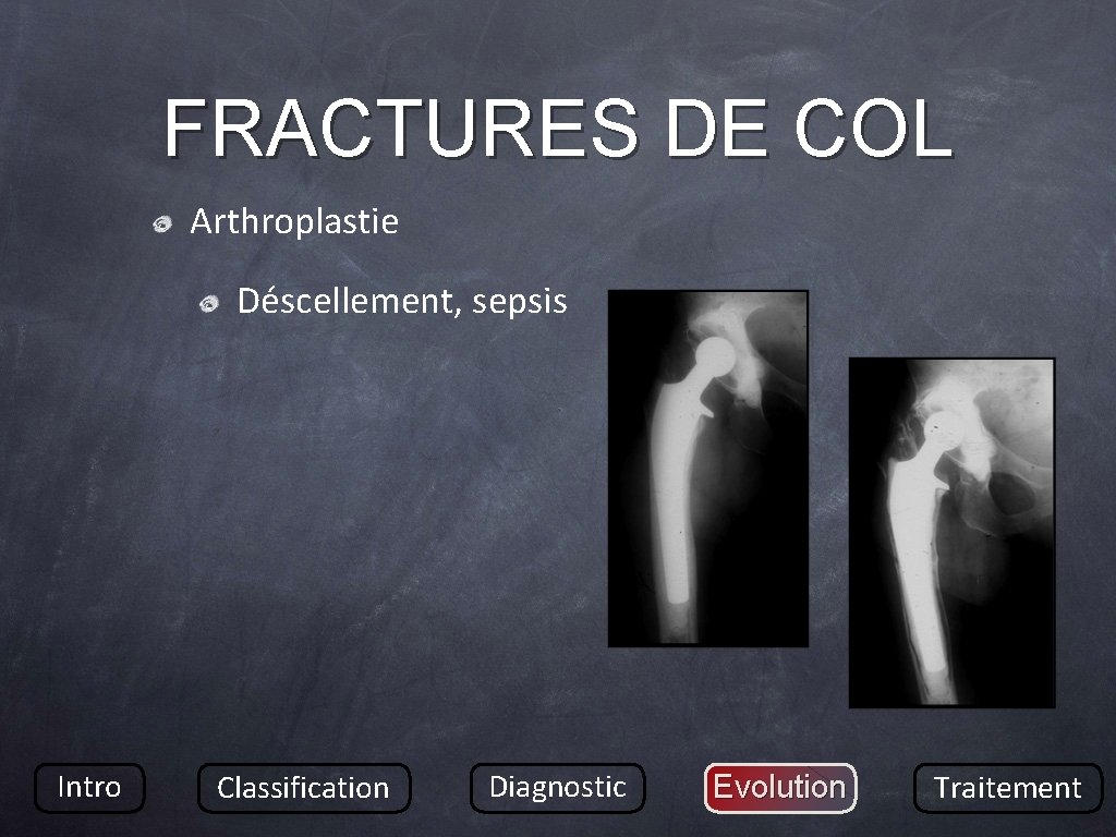 FRACTURES DE COL Arthroplastie Déscellement, sepsis Intro Classification Diagnostic Evolution Traitement 