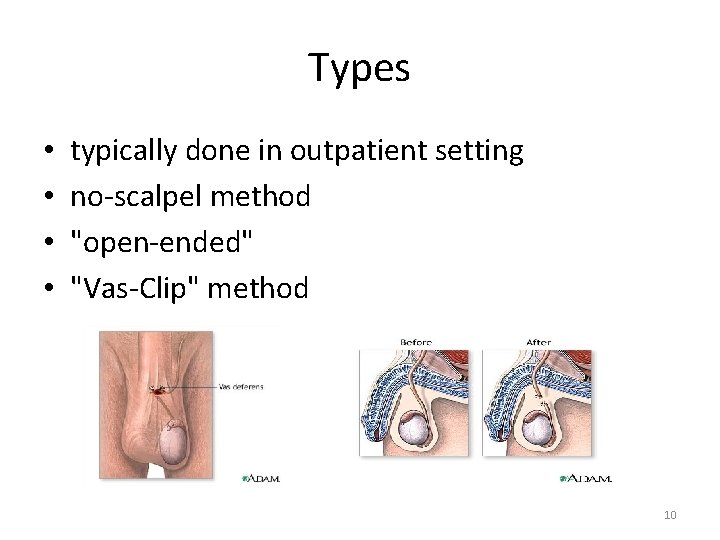 Types • • typically done in outpatient setting no-scalpel method "open-ended" "Vas-Clip" method 10