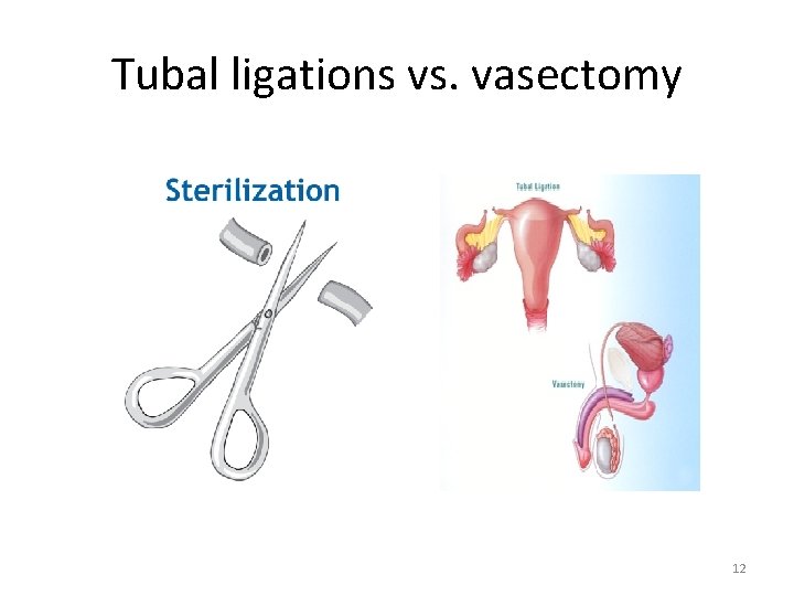 Tubal ligations vs. vasectomy 12 