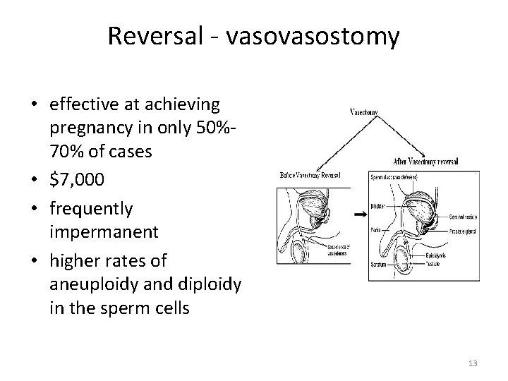 Reversal - vasostomy • effective at achieving pregnancy in only 50%70% of cases •