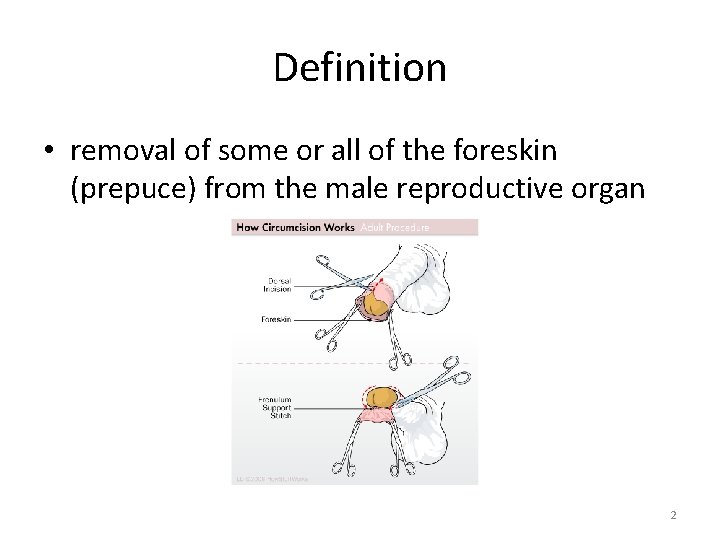 Definition • removal of some or all of the foreskin (prepuce) from the male